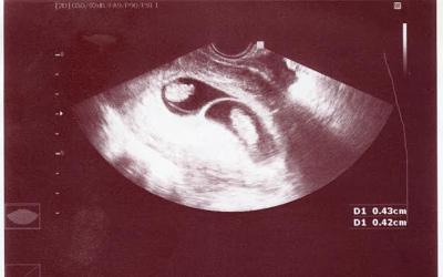 Znakovi višeplodne trudnoće
