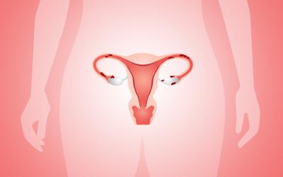 Endometrioza – od postavljanja dijagnoze do začeća