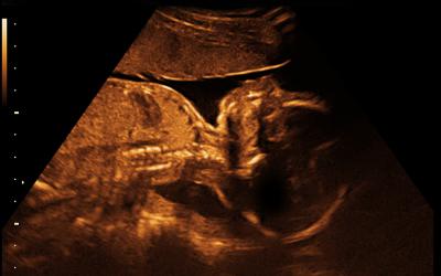 Ultrazvuk u trudnoći