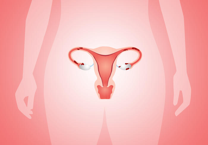 Endometrioza Od Postavljanja Dijagnoze Do Zaceca Roda
